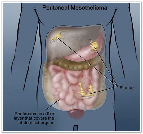 pd l1 expression mesothelioma